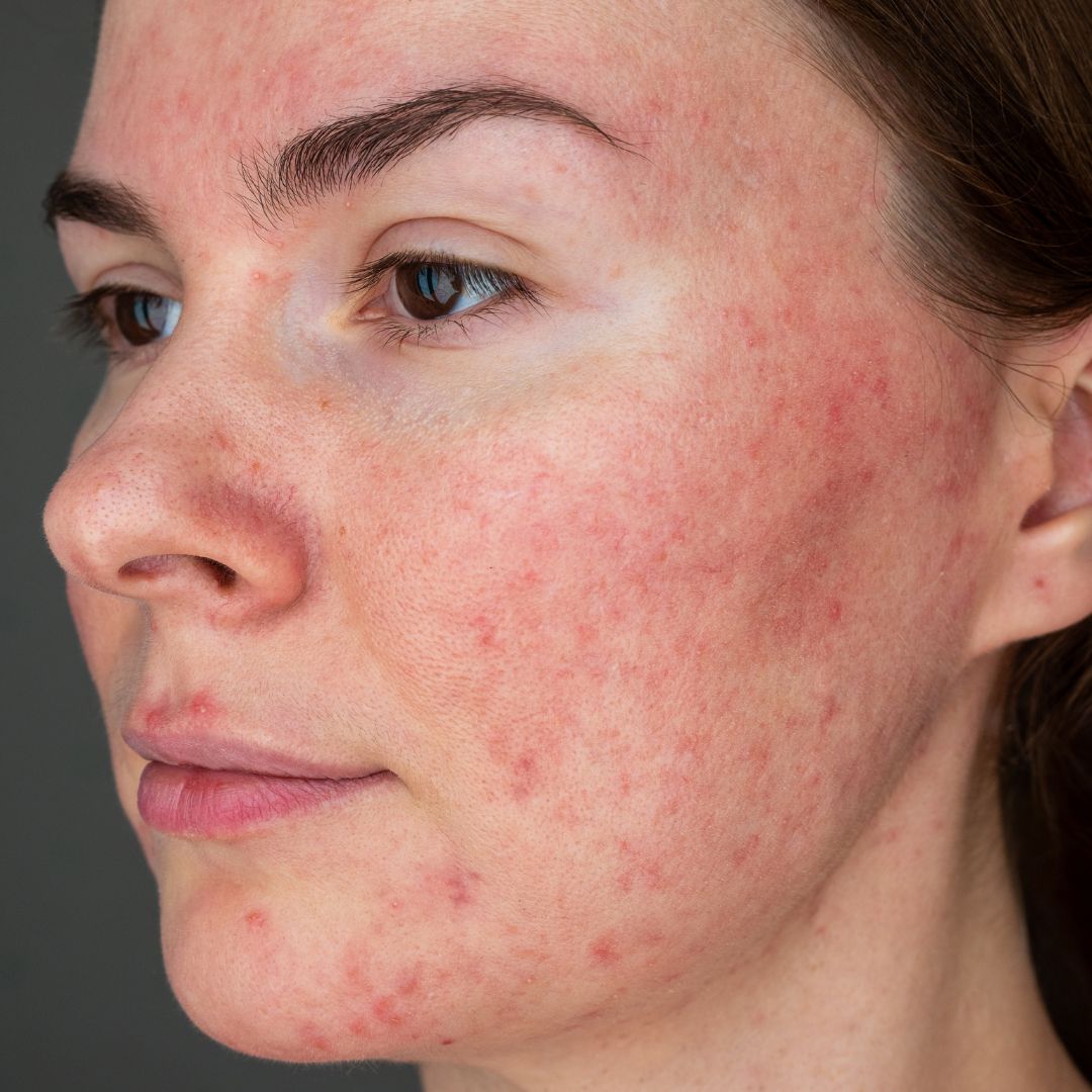 Rosacea a kuperóza